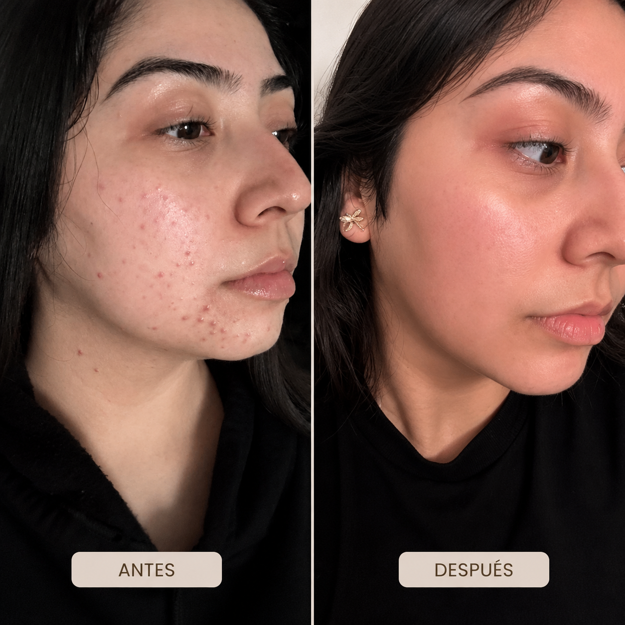 ANUA Sérum Corrector de Manchas Niacinamida 10% + Ácido Tranexámico 4%